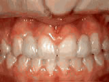 missing lateral incisors after